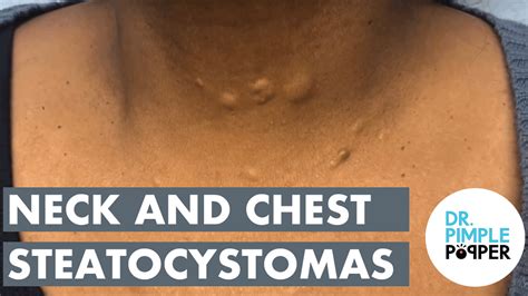 Steatocystomas popping - This patient found me on YouTube. Thanks to her for sharing her procedure. Very interesting large steatocystomas in a sensitive area. We will be doing multip...